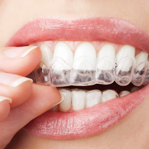 Close-up of whitening tray being placed over teeth