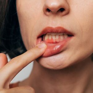 Lady shows inflamed gums