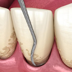 Illustration of scaling and root planing process