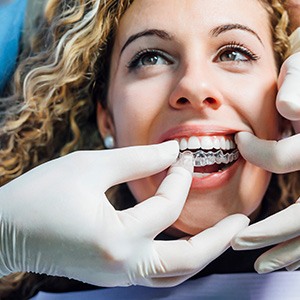 Dentist with white gloves removing a patient’s Invisalign