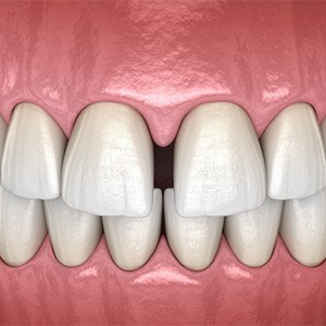 Closeup rendering of a diastema 