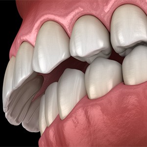 Rendering of an overbite with a black background