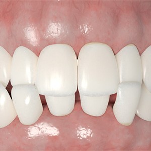 Frontal rendering of a crossbite with white background