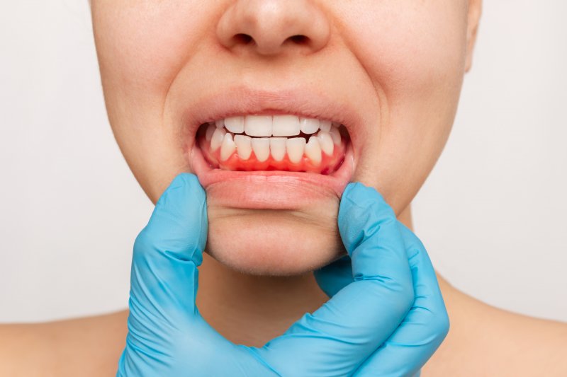 Woman with gum disease 